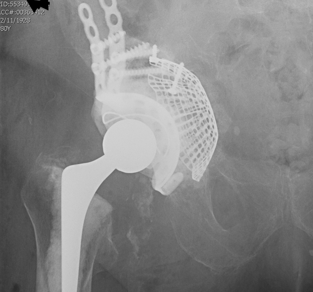 Revision Acetabulum Post Paprosky Type IIIC